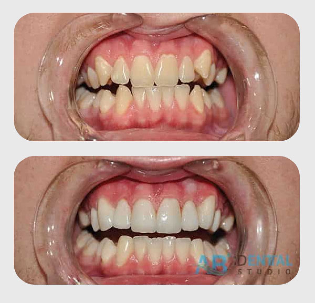 Resultados de blanqueamiento dental antes y después en A.B. Dental Studio – sonrisa más blanca