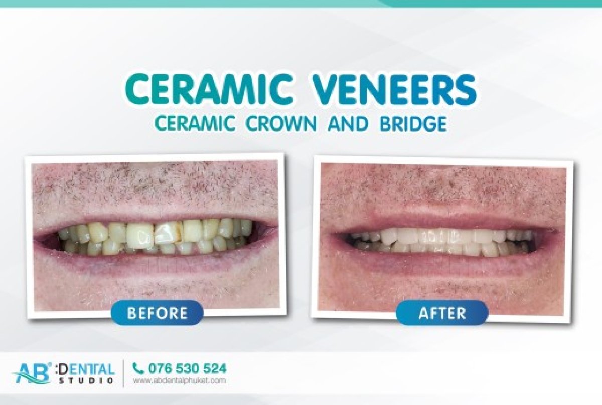 نتائج قبل وبعد قشور السيراميك في A.B. Dental Studio – تحسين جمالية الابتسامة