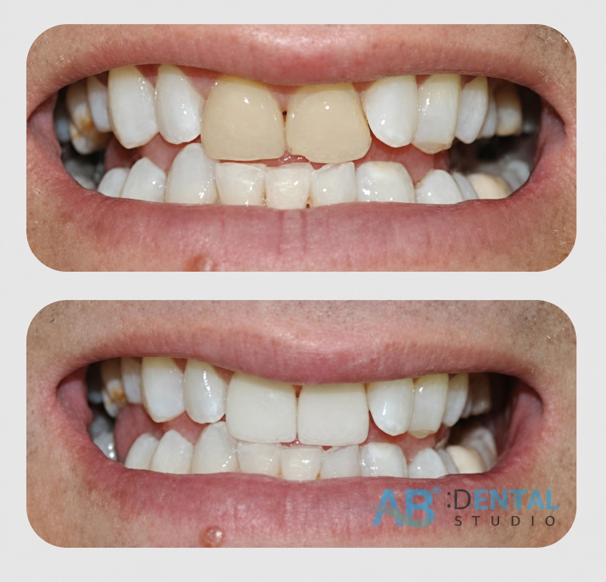 Resultados de carillas de porcelana antes y después en A.B. Dental Studio – sonrisa mejorada