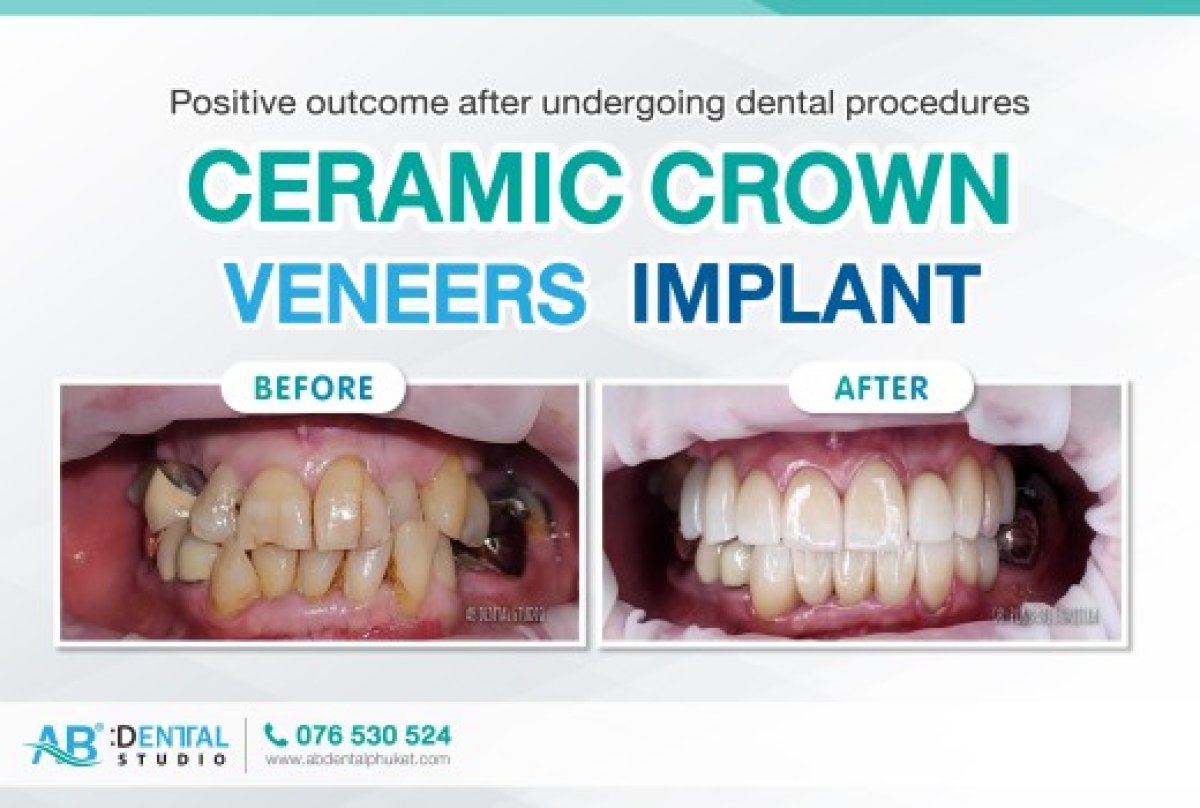 Resultados antes y después de coronas de porcelana en A.B. Dental Studio, sonrisa mejorada