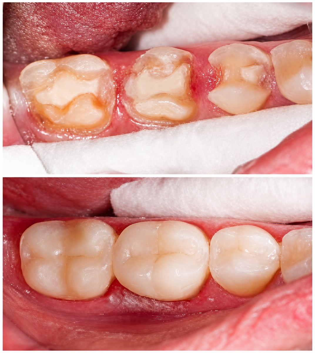 Resultados antes y después de empaste compuesto en Pattaya Smile Dental Clinic, molares restaurados