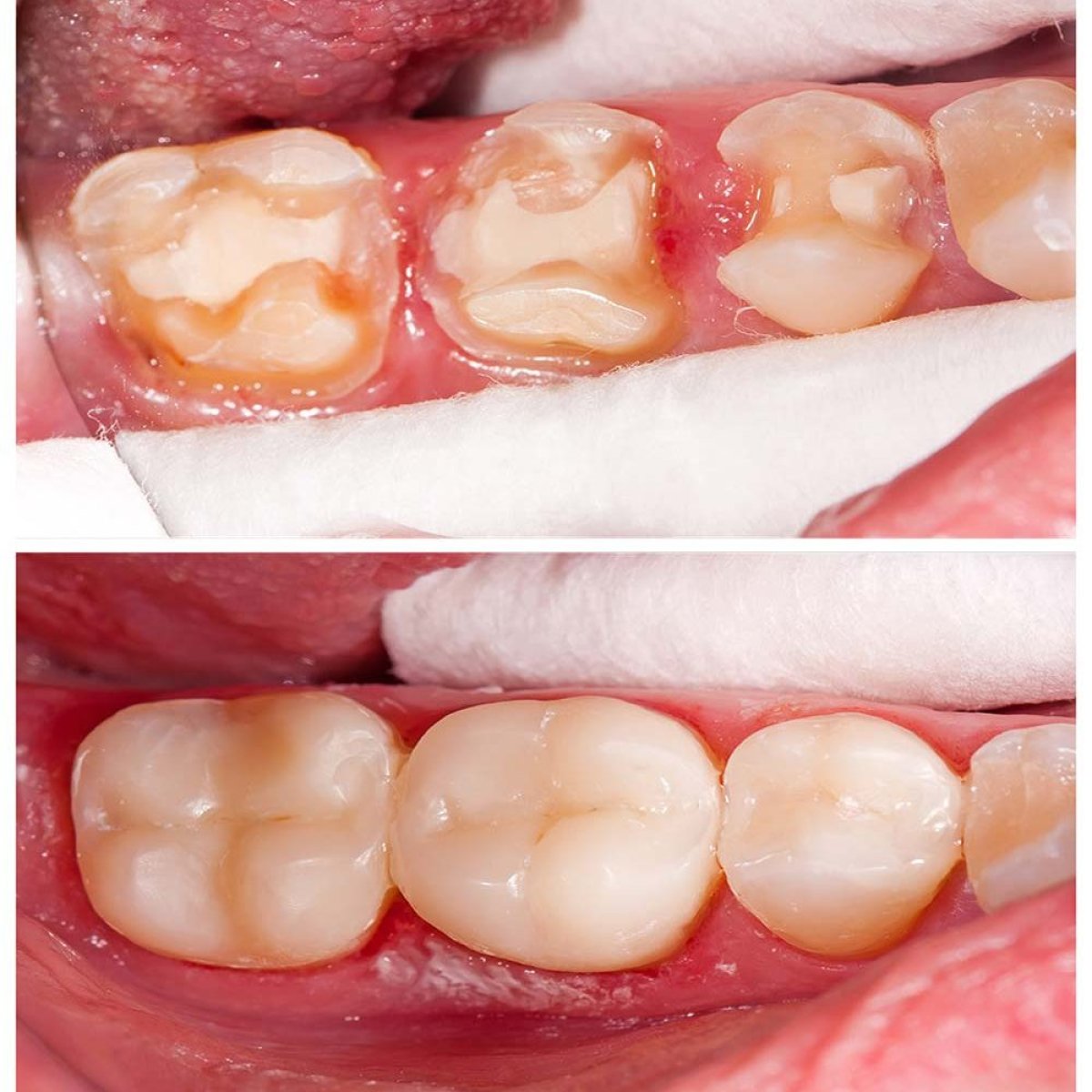 نتائج قبل وبعد حشو تجميلي للأضراس في عيادة Pattaya Smile Dental Clinic
