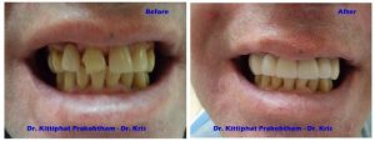 Resultados de blanqueamiento dental antes y después en Pattaya Smile Dental Clinic, sonrisa más brillante