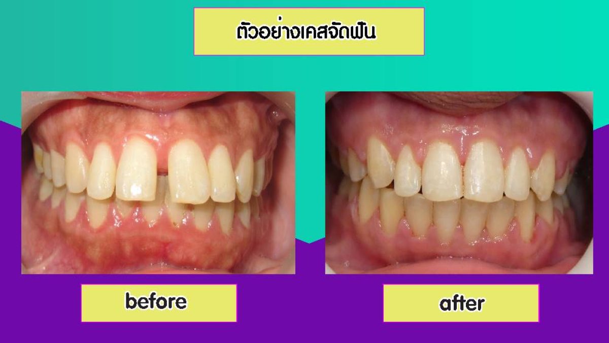 نتائج تبييض الأسنان قبل وبعد في Pattaya Smile Dental Clinic، ابتسامة أكثر إشراقًا