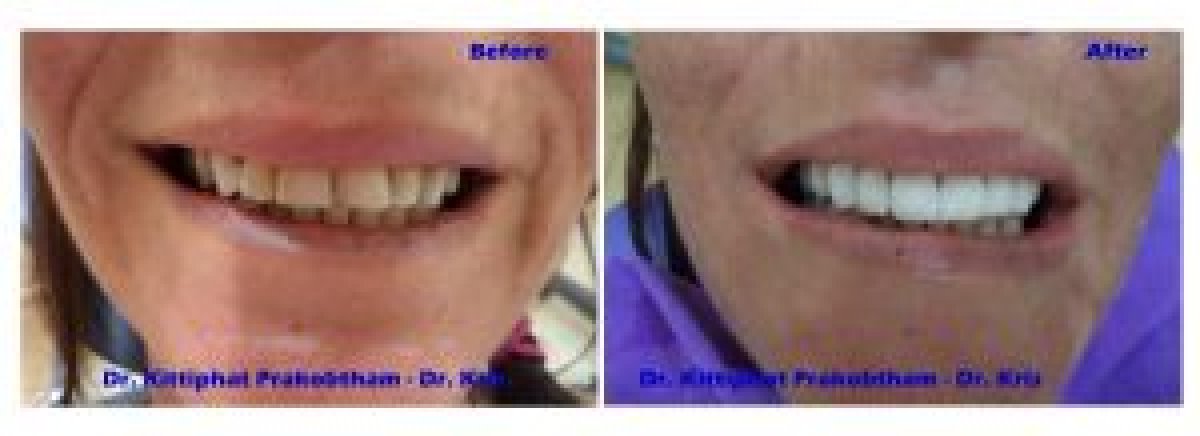 Resultados de blanqueamiento dental antes y después en Pattaya Smile Dental Clinic, sonrisa más brillante