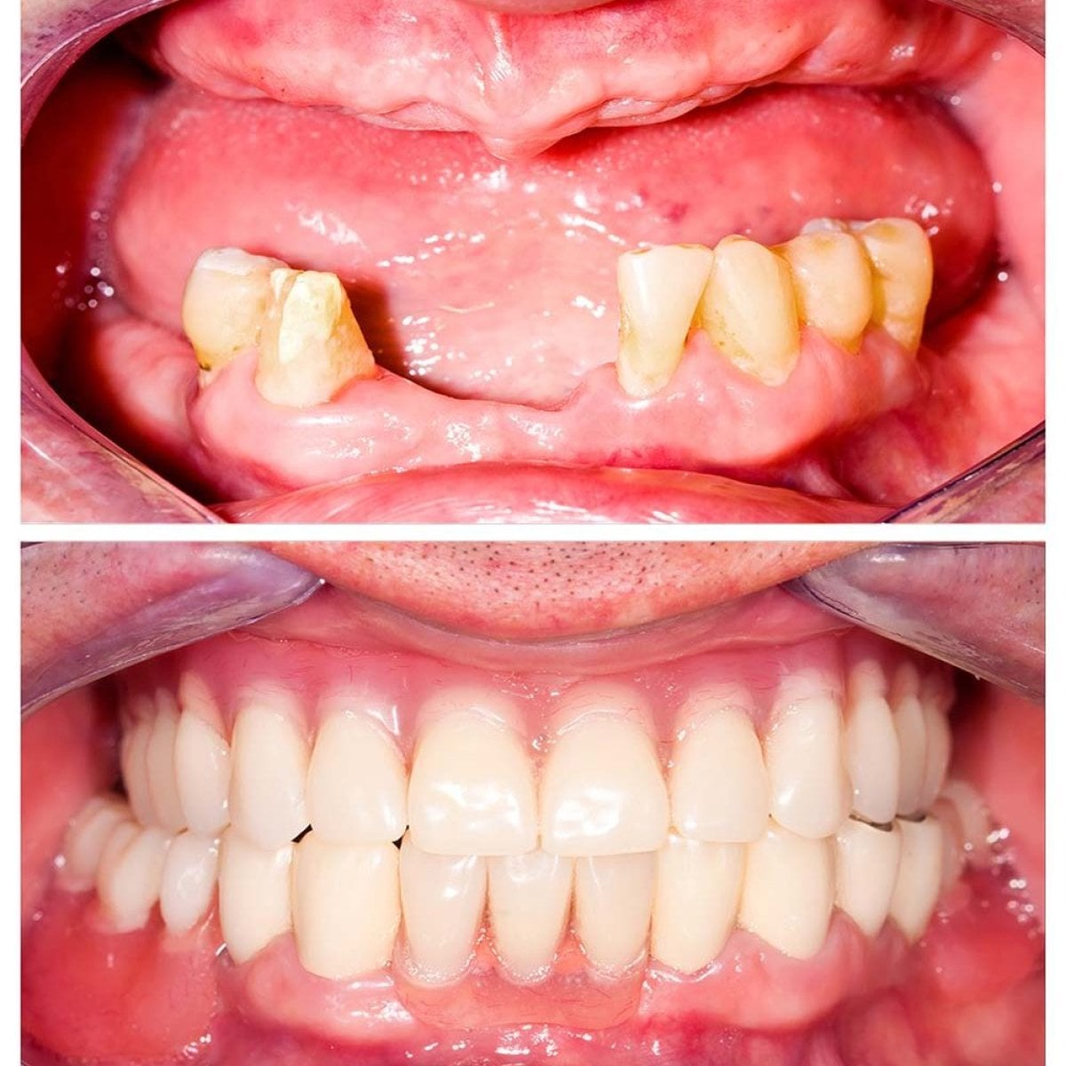 قبل وبعد تركيب أطقم الأسنان الكاملة في Pattaya Smile Dental Clinic، نتيجة استعادة الابتسامة