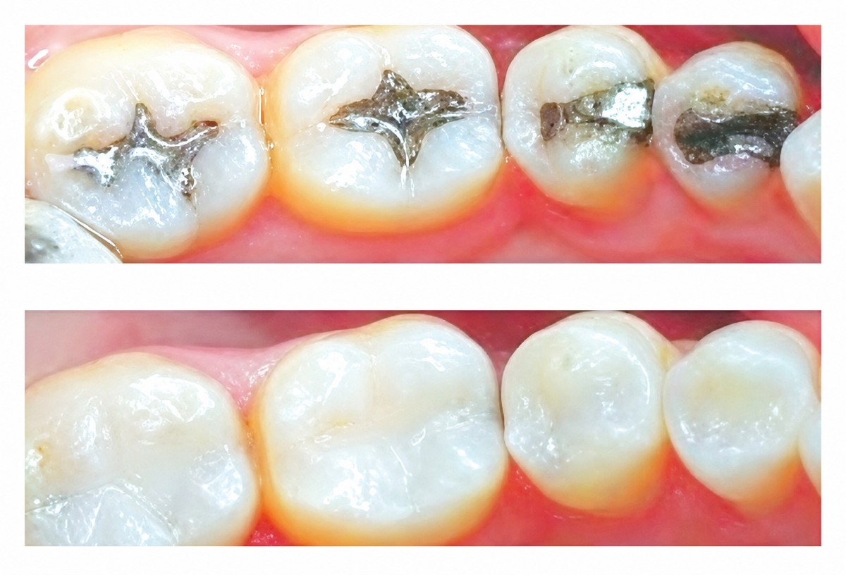 نتائج قبل وبعد حشو الكمبوزيت في Phuket Dental Studio، ترميم طبيعي للأسنان