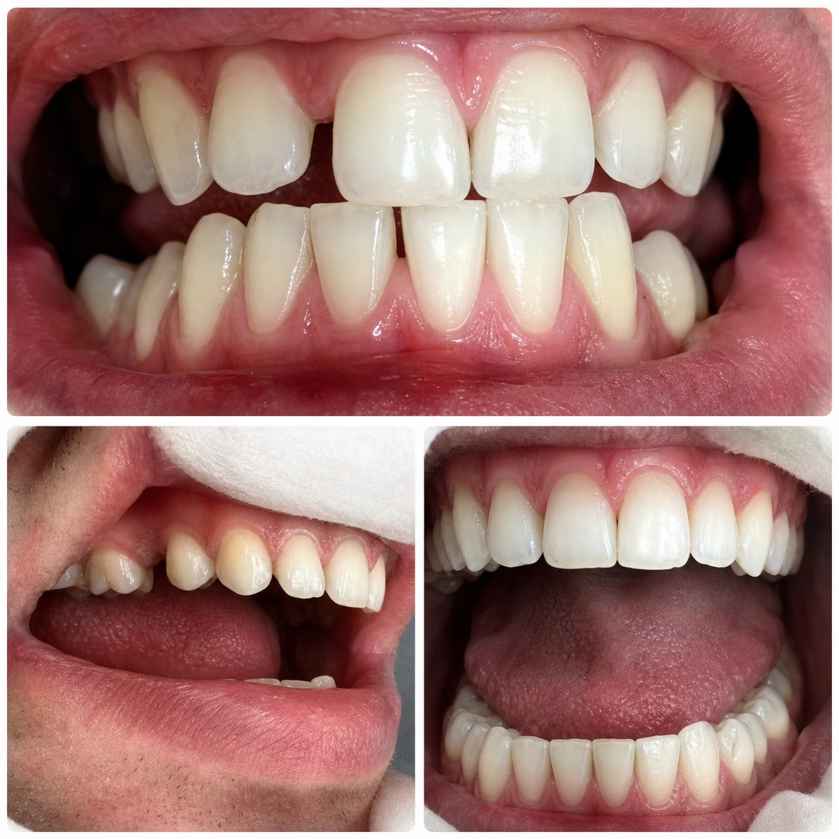 Resultados de blanqueamiento dental antes y después en Phuket Dental Studio, sonrisa más blanca