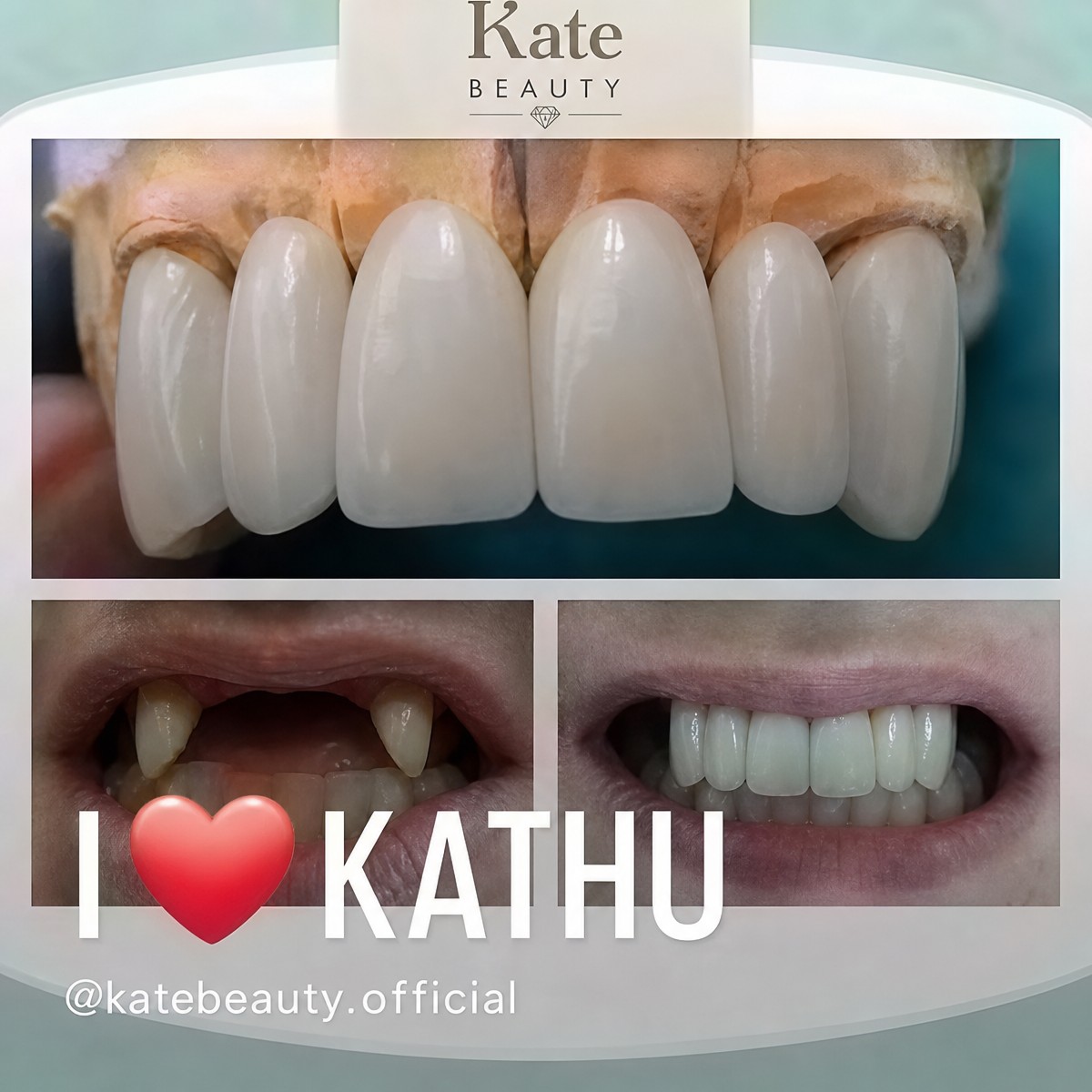 Resultados de implantes dentales antes y después en Phuket Dental Studio, sonrisa restaurada