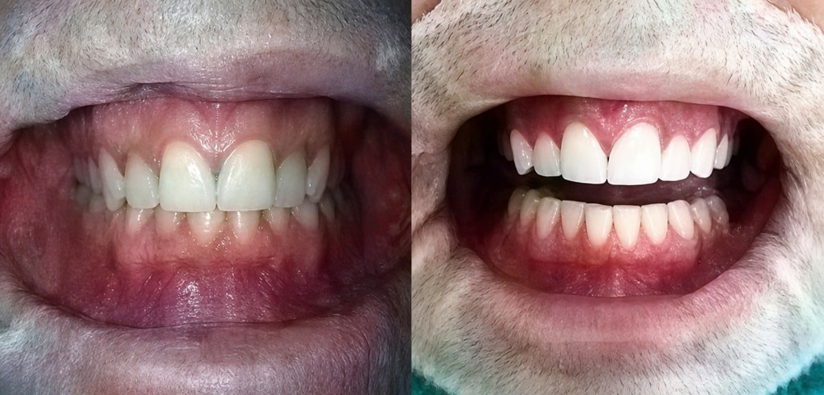 نتائج تبييض الأسنان قبل وبعد في Phuket Dental Studio، ابتسامة أكثر إشراقًا