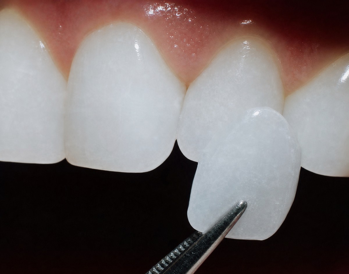 نتيجة ترابط الأسنان في Phuket Dental Studio، تحسين مظهر الأسنان وجمال الابتسامة