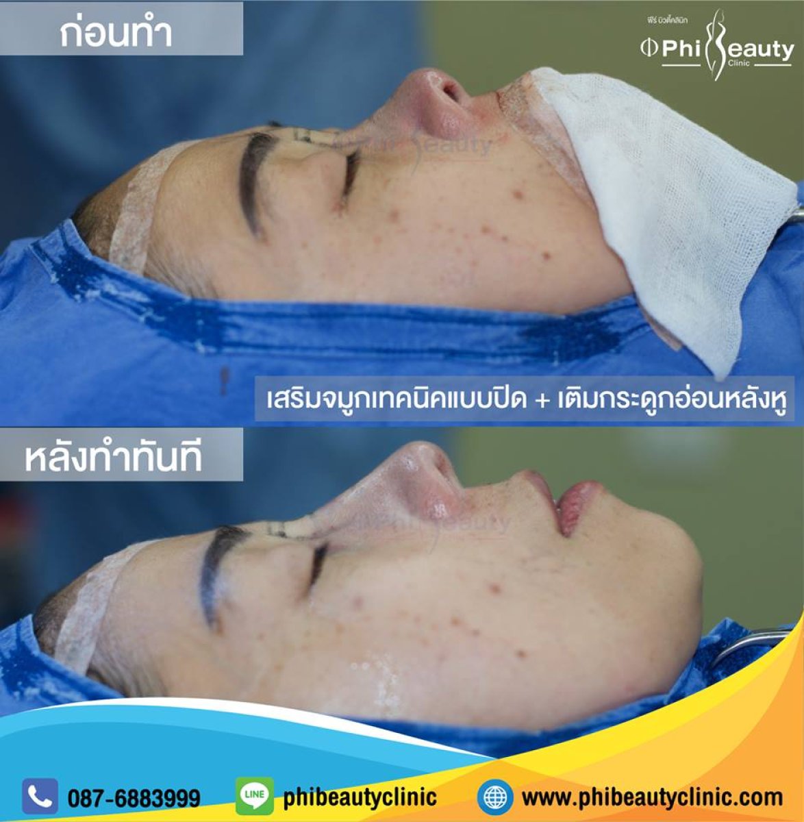 Resultados de rinoplastia antes y después en Phi Beauty Clinic, mejor forma y perfil nasal