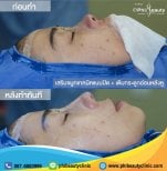 نتائج تجميل الأنف قبل وبعد في Phi Beauty Clinic، تحسين شكل الأنف والملف الجانبي