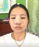 نتيجة التعافي بعد عملية تجميل الأنف في Phi Beauty Clinic، الأنف مغطى بضماد