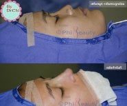 نتائج تجميل الأنف قبل وبعد في Phi Beauty Clinic، تحسين شكل الأنف والملف الجانبي