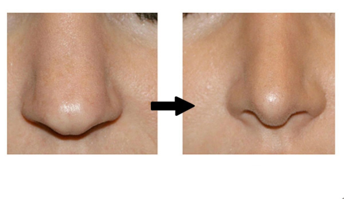 Resultados antes y después de rinoplastia de punta en Phi Beauty Clinic, mejora nasal