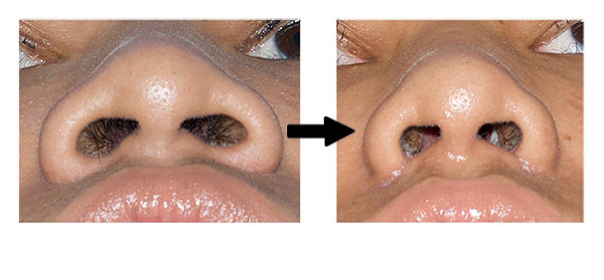 Resultados antes y después de alarplastia en Phi Beauty Clinic, reducción de las fosas nasales