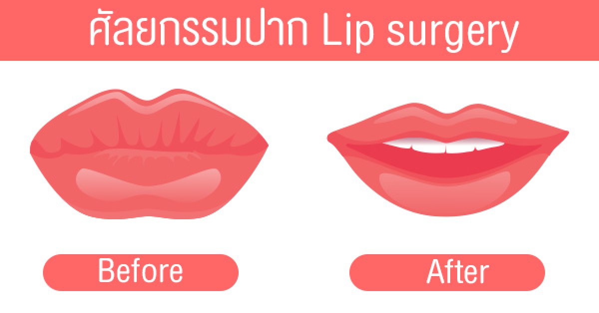 Resultados antes y después de reducción de labios en Phi Beauty Clinic, labios más delgados