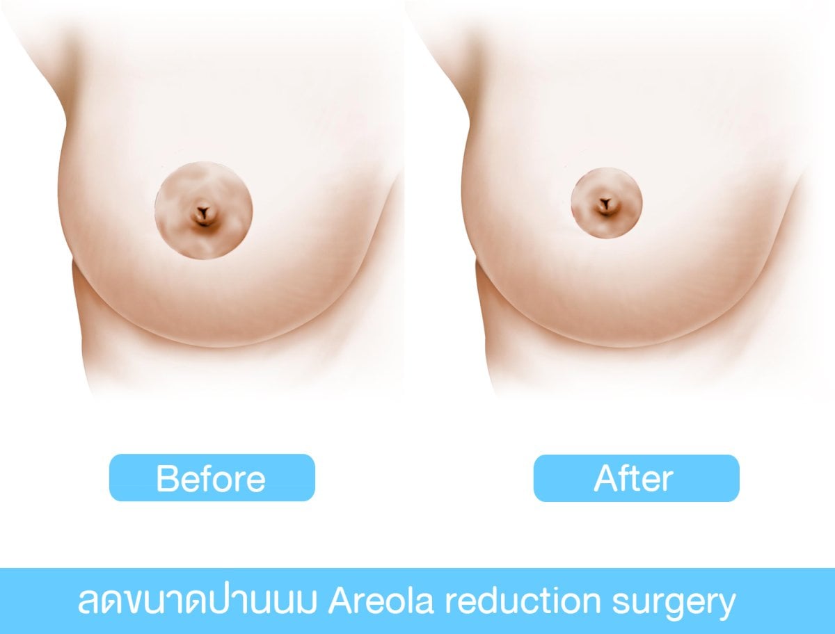Resultados de reducción de areola antes y después en Phi Beauty Clinic – areola más pequeña