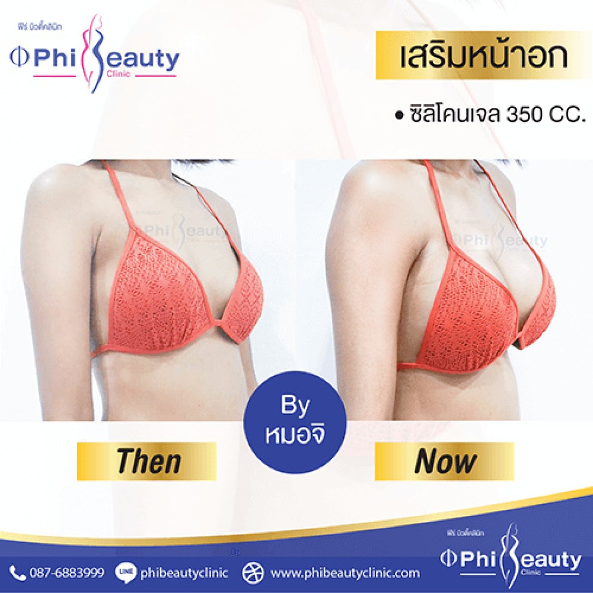 نتائج تكبير الثدي بحشوات ملحية في Phi Beauty Clinic قبل وبعد، نتائج واضحة