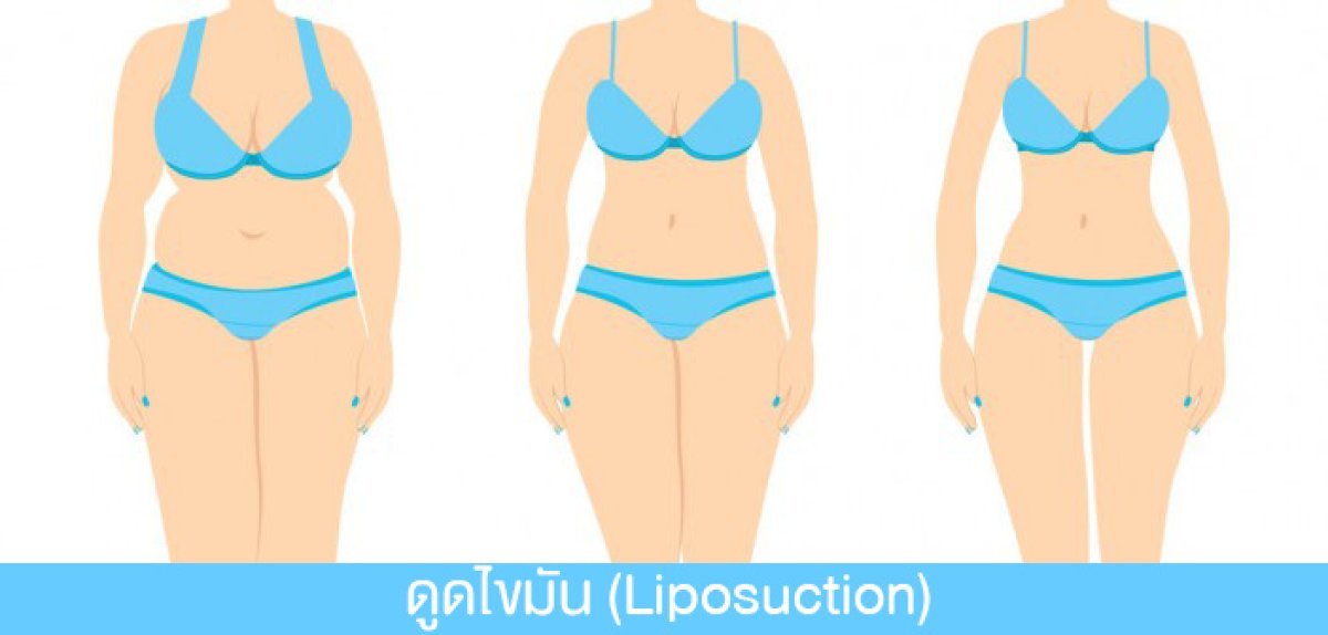 Resultados de liposucción antes y después en Phi Beauty Clinic, mejora visible del contorno corporal