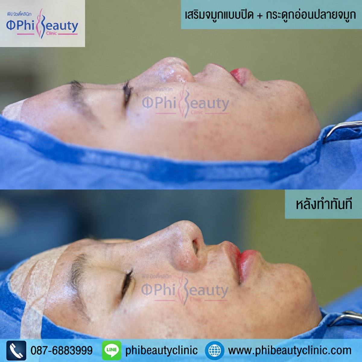 قبل وبعد إزالة حدبة الأنف في Phi Beauty Clinic، تحسين شكل الأنف