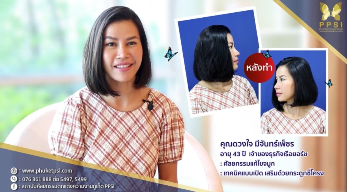 Resultados de otoplastia en Phuket Plastic Surgery Institute – forma y simetría de orejas mejoradas