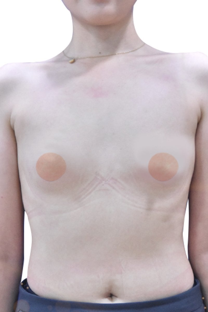 Resultado de reducción de senos en Phuket Plastic Surgery Institute – contorno natural