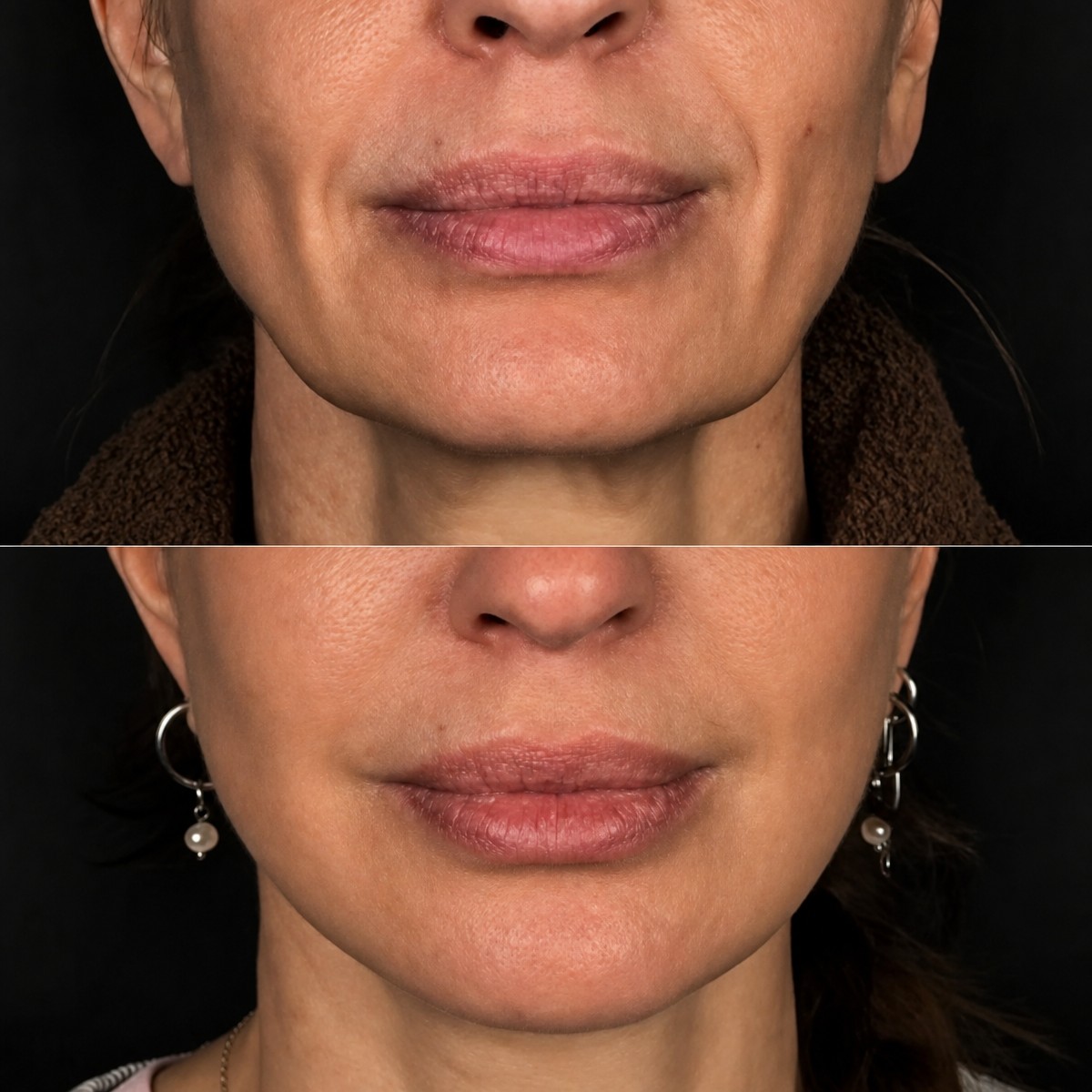 Resultados de lifting facial antes y después en Dmytrii Homola Clinic – rostro más joven