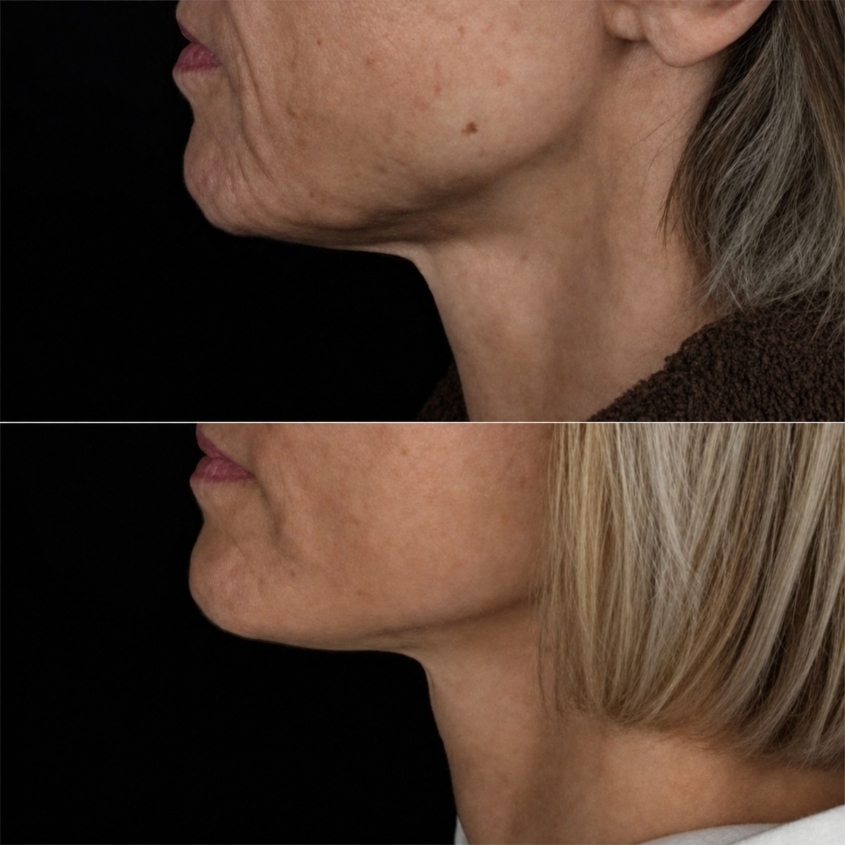Resultados de lifting facial antes y después en Dmytrii Homola Clinic – mejor contorno facial y cuello