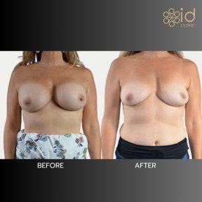Результаты до и после подтяжки груди в ID Clinic Bangkok, улучшенная форма груди