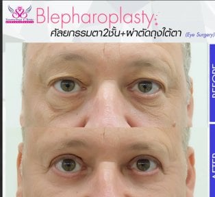 before-after photo blepharoplasty-eyelid