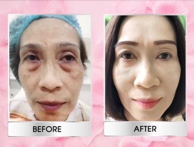 before-after photo blepharoplasty-eyelid