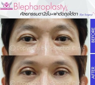 before-after photo blepharoplasty-eyelid