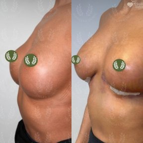 before-after photo breast-implant-revision
