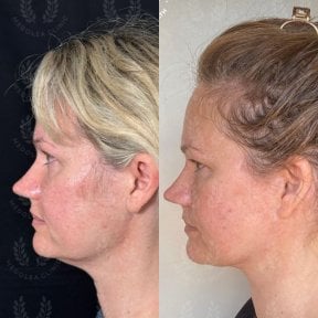 before-after photo tightening-of-facial-skin-facelift