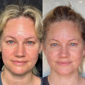 before-after photo tightening-of-facial-skin-facelift
