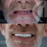 Before and after Same day All-on-4 dental implants result at Nifa Dent International clinic