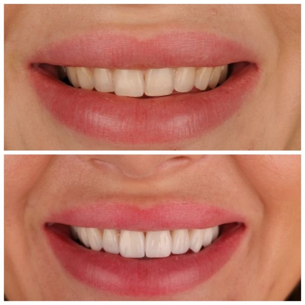 قبل وبعد الفينير في عيادة RIKOTA Dental Clinic – تحول الابتسامة بنتائج طبيعية
