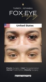 before-after photo upper-eyelid-surgery
