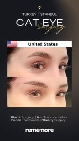 before-after photo upper-eyelid-surgery