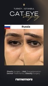 before-after photo upper-eyelid-surgery