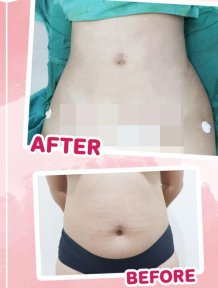 before-after photo vaser-liposuction