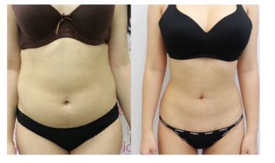 before-after photo vaser-liposuction
