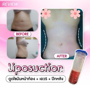 before-after photo vaser-liposuction