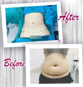 before-after photo vaser-liposuction