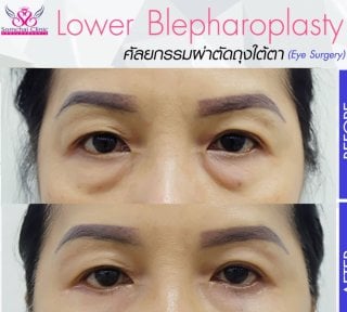 before-after photo upper-eyelid-surgery