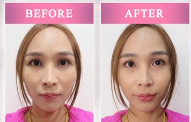 before-after photo fillers-injection