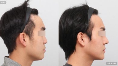 before-after photo rhinoplasty-nose-job