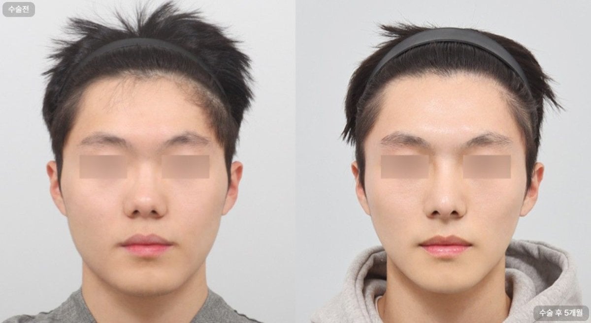 Resultados de rinoplastia antes y después en AB Plastic Surgery Clinic, forma de nariz mejorada
